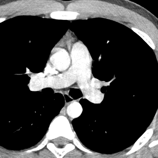 File:Normal CT pulmonary veins (pre RF ablation) (Radiopaedia 41748-44702 A 77).png