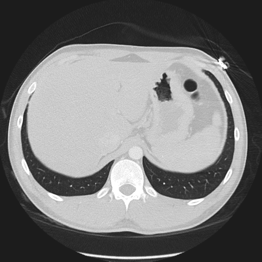 Normal CT pulmonary veins (pre RF ablation) (Radiopaedia 41748-44702 Axial lung window 67).png