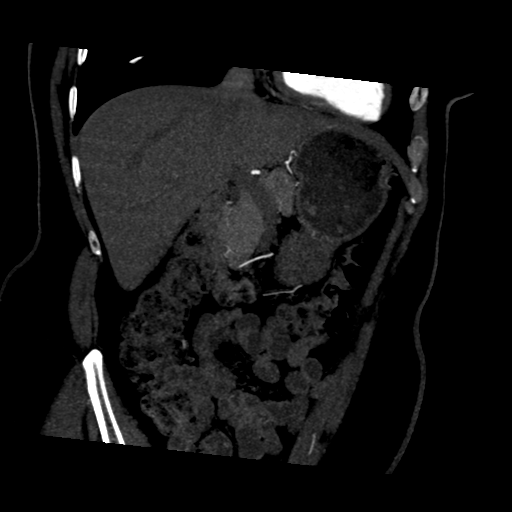 File:Normal CT renal artery angiogram (Radiopaedia 38727-40889 D 5).png