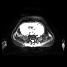 Normal MRI abdomen in pregnancy (Radiopaedia 88001-104541 Axial DWI 18).jpg