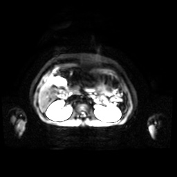 Normal MRI abdomen in pregnancy (Radiopaedia 88001-104541 Axial DWI 37).jpg