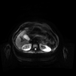 Normal MRI abdomen in pregnancy (Radiopaedia 88001-104541 Axial DWI 83).jpg