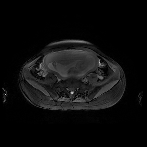 File:Normal MRI abdomen in pregnancy (Radiopaedia 88001-104541 D 39).jpg