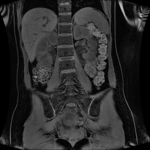 Normal MRI abdomen in pregnancy (Radiopaedia 88001-104541 M 92).jpg