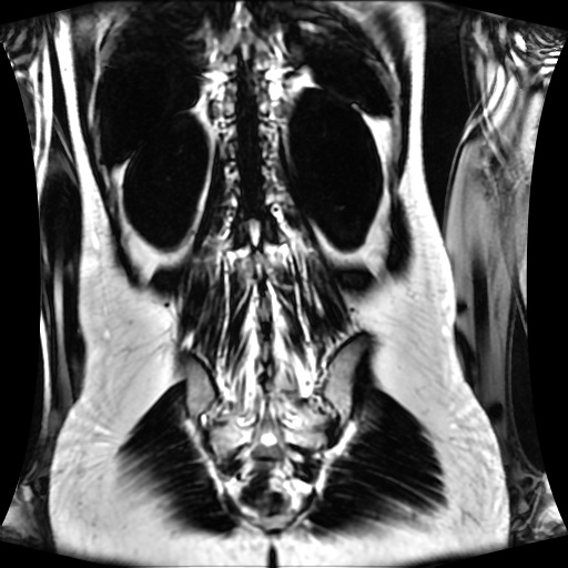 Normal MRI abdomen in pregnancy (Radiopaedia 88001-104541 N 109).jpg