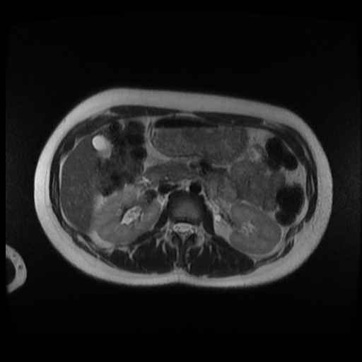 Normal MRI abdomen in pregnancy (Radiopaedia 88003-104546 Axial T2 10).jpg