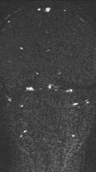Normal MRI brain with MRV- teenager (Radiopaedia 49425-54553 Coronal MRV 134).jpg