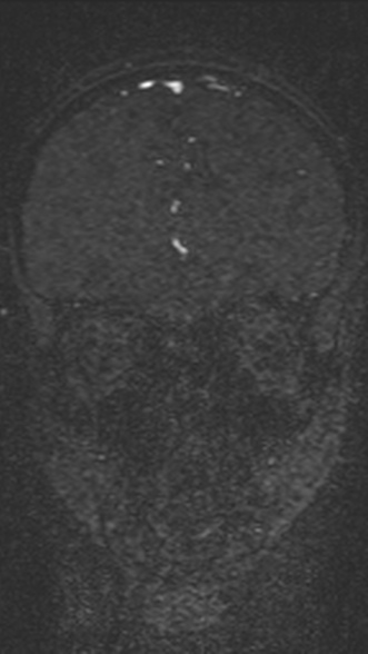 Normal MRI brain with MRV- teenager (Radiopaedia 49425-54553 Coronal MRV 79).jpg