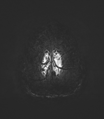 Normal MRI internal auditory canal (Radiopaedia 41613-44525 Axial SWI MIP 79).png