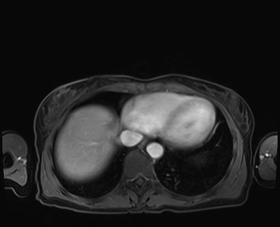 Normal adrenal glands MRI (Radiopaedia 82017-96004 K 7).jpg