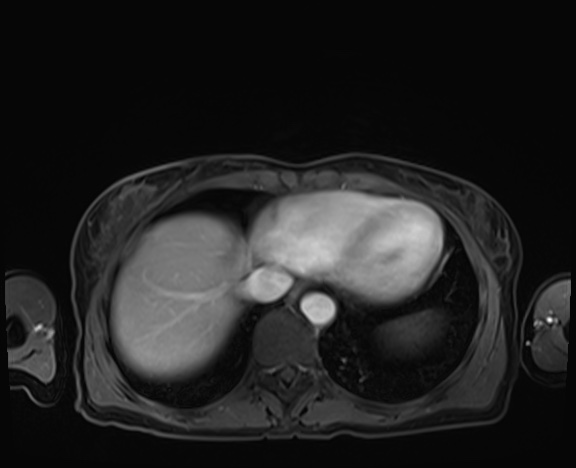 Normal adrenal glands MRI (Radiopaedia 82017-96004 K 8).jpg