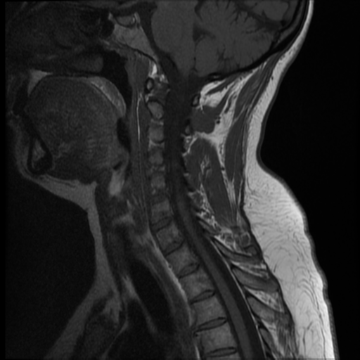 File:Normal cervical and thoracic spine MRI (Radiopaedia 35630-37156 Sagittal T1 8).png