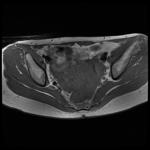 File:Normal female pelvis MRI (retroverted uterus) (Radiopaedia 61832-69933 Axial T1 16).jpg