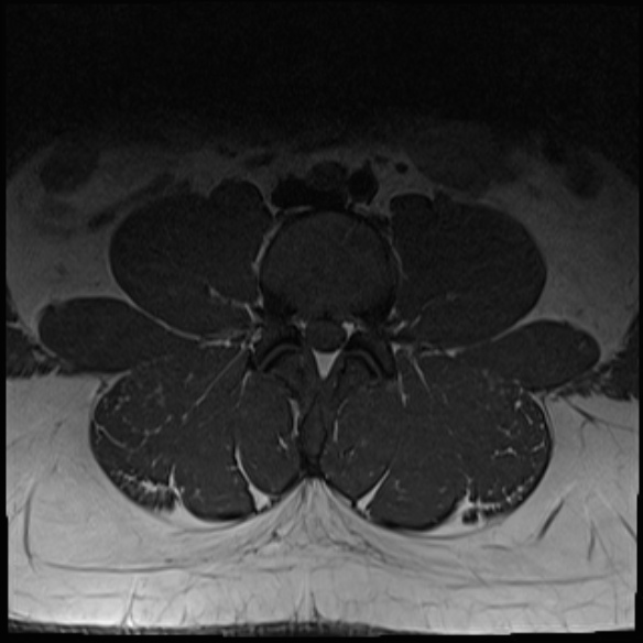 File:Normal lumbar spine MRI (Radiopaedia 47857-52609 Axial T1 10).jpg