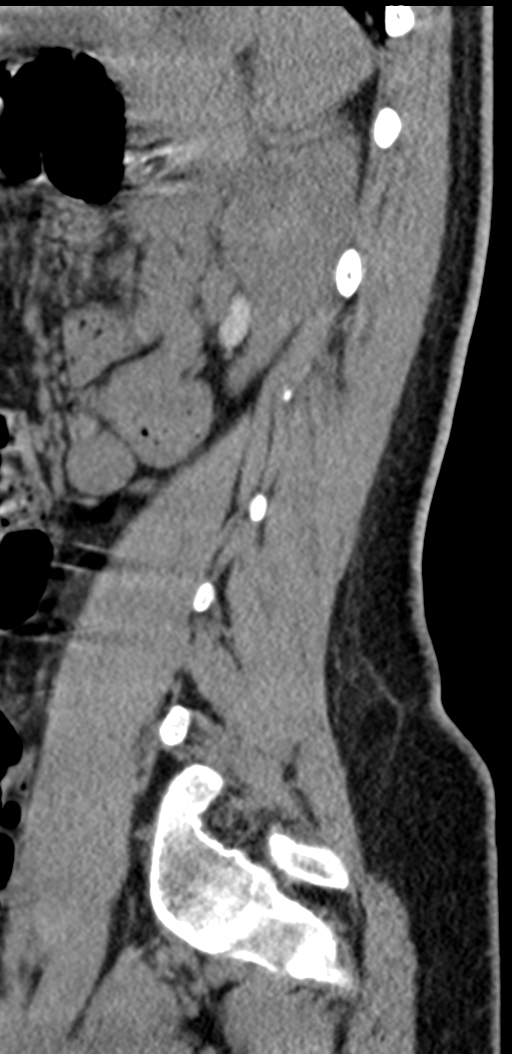 Normal lumbosacral CT (Radiopaedia 37923-39867 E 29).png