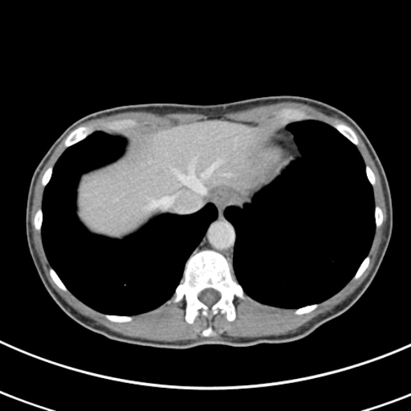 File:Normal multiphase CT liver (Radiopaedia 38026-39996 C 6).jpg