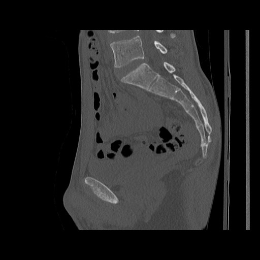 Normal pelvis (Radiopaedia 51473-57238 Sagittal bone window 79).jpg