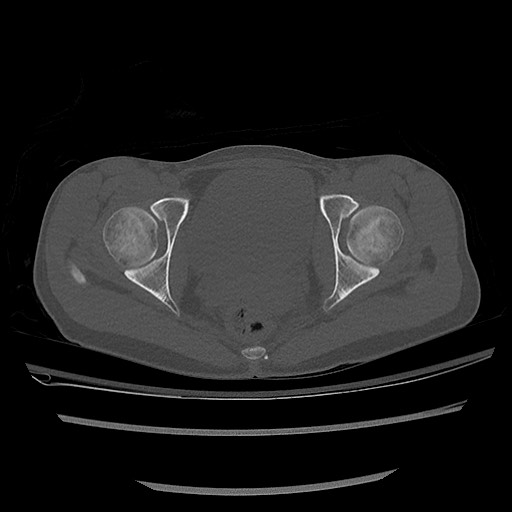 Normal pelvis CT (Radiopaedia 51471-57236 Axial bone window 73).jpg