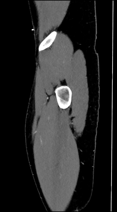 Normal pelvis CT angiogram (Radiopaedia 84966-100481 C 101).jpg