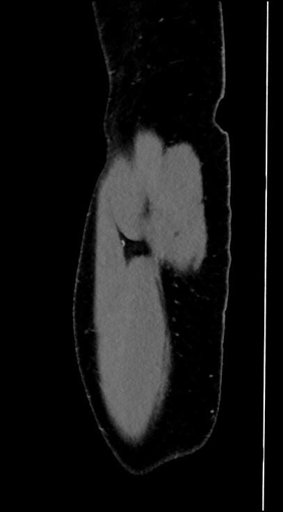 Normal pelvis CT angiogram (Radiopaedia 84966-100481 C 107).jpg