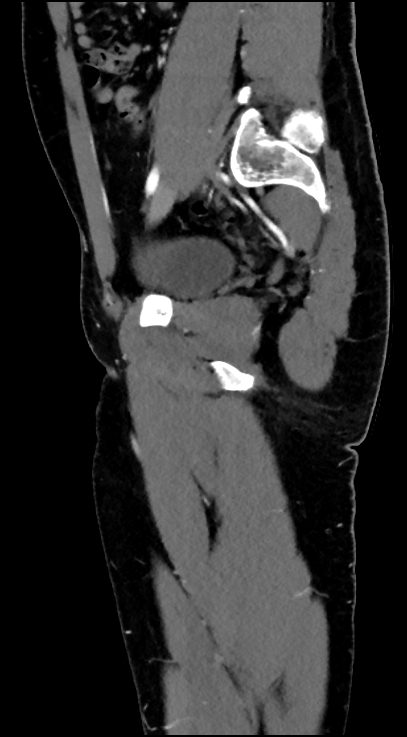 Normal pelvis CT angiogram (Radiopaedia 84966-100481 C 42).jpg