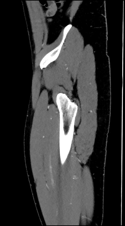 Normal pelvis CT angiogram (Radiopaedia 84966-100481 C 94).jpg