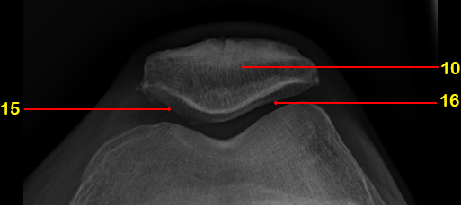 File:Normal radiographic anatomy of the knee (Radiopaedia 42948-46192 Sunrise 1).jpg