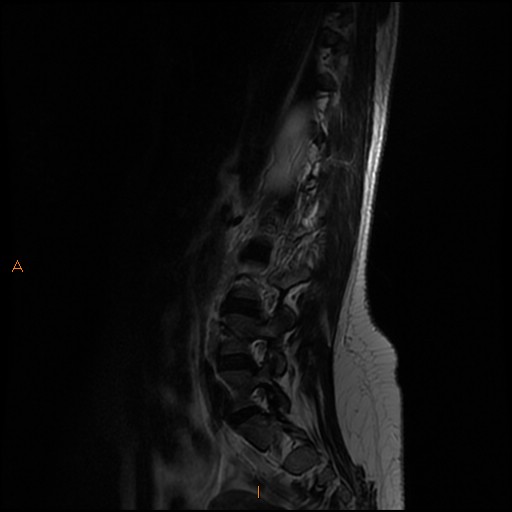 File:Normal spine MRI (Radiopaedia 77323-89408 Sagittal T2 11).jpg