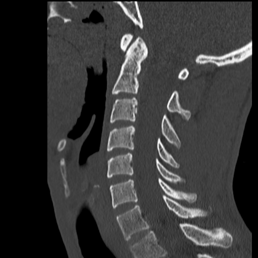File:Normal trauma cervical spine (Radiopaedia 41017-43760 Sagittal bone window 23).png