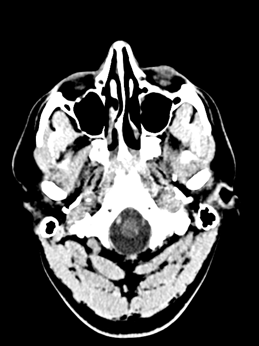 Normal trauma protocol brain and C-spine CT (Radiopaedia 83302-97709 Axial non-contrast 64).jpg