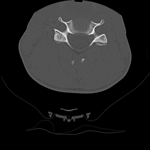 Normal trauma spine imaging (age 16) (Radiopaedia 45335-49358 Axial bone window 43).jpg