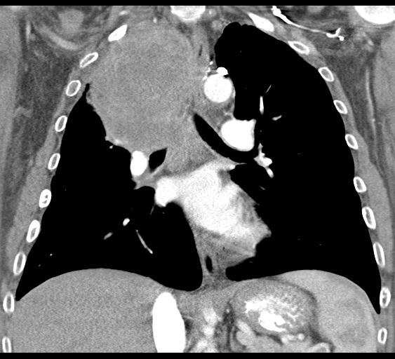 File:Obstructive superior vena cava tumor thrombus (Radiopaedia 28046-28306 B 27).jpg