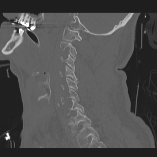 File:Occipital condyle fracture (Radiopaedia 33467-34517 Sagittal bone window 49).png