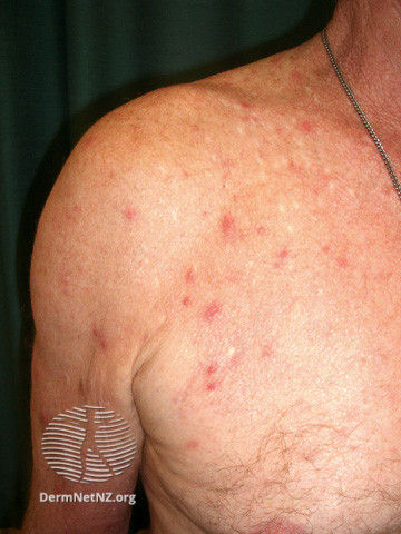 Rosacea (DermNet NZ acne-red-face-3621).jpg