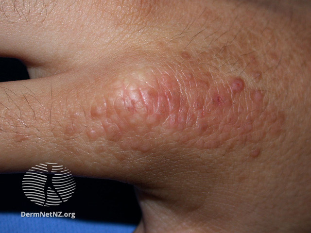 File:(DermNet NZ dermatitis-lichen-simplex-3119).jpg