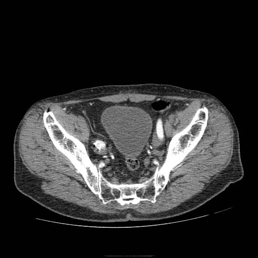 Abdominal aortic aneurysm (Radiopaedia 13341-13340 Axial C+ arterial phase 213).jpg
