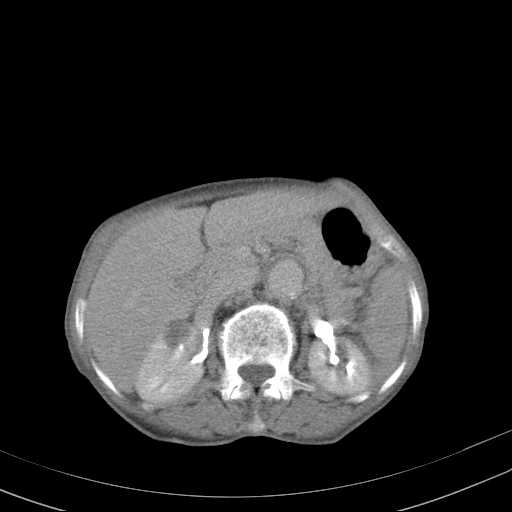 File:Abdominal aortic aneurysm (Radiopaedia 20827-20742 Axial C+ delayed 10).jpg