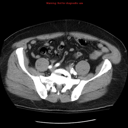 Abdominal aortic aneurysm (Radiopaedia 8190-9038 Axial C+ arterial phase 61).jpg