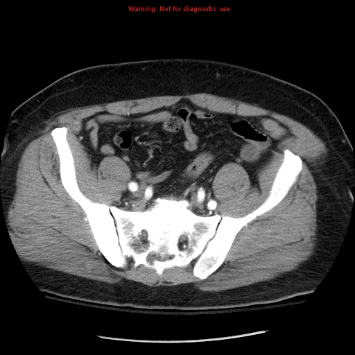 File:Abdominal aortic aneurysm (Radiopaedia 8190-9038 Axial C+ arterial phase 64).jpg