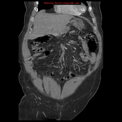 Abdominal aortic aneurysm (Radiopaedia 8190-9038 Coronal C+ arterial phase 30).jpg
