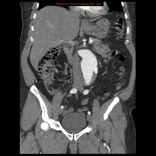 Abdominal aortic aneurysm (Radiopaedia 8190-9038 Coronal C+ arterial phase 59).jpg