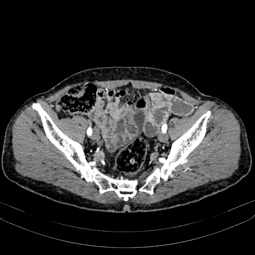 File:Abdominal aortic aneurysm (Radiopaedia 83581-98689 Axial C+ arterial phase 96).jpg