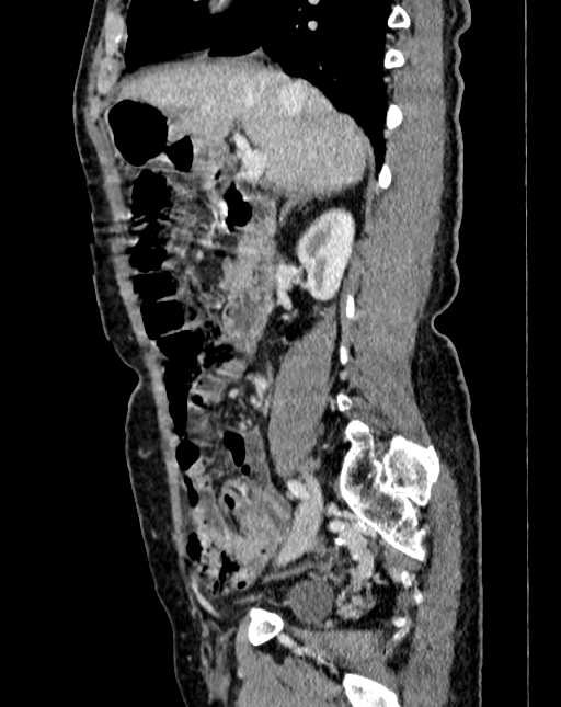 Abdominal aortic aneurysm (Radiopaedia 83581-98689 Sagittal C+ portal venous phase 18).jpg