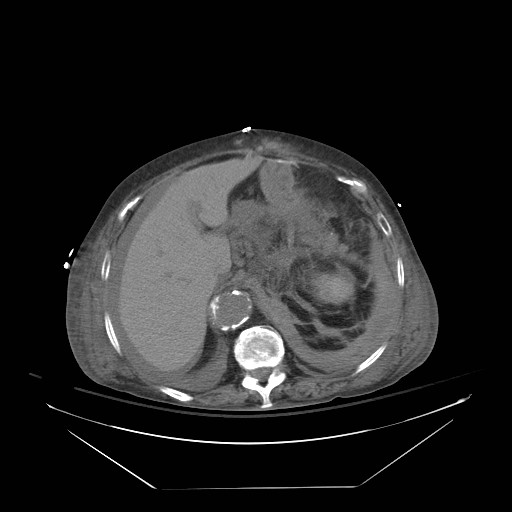 Abdominal aortic aneurysm - impending rupture (Radiopaedia 19233-19247 Axial non-contrast 48).jpg