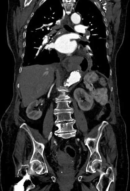 Abdominal aortic aneurysm with thrombus fissuration (Radiopaedia 73192-83919 Coronal C+ arterial phase 52).jpg
