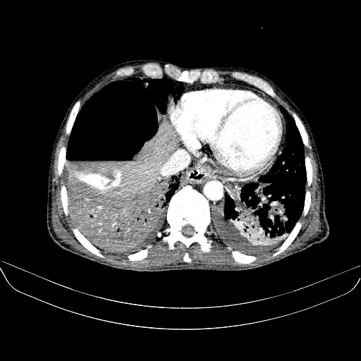 File:Abdominal collection due to previous cecal perforation (Radiopaedia 80831-94320 Axial C+ portal venous phase 15).jpg