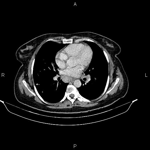 File:Abdominal lymphoma with sandwich sign (Radiopaedia 84378-99704 Axial C+ portal venous phase 1).jpg