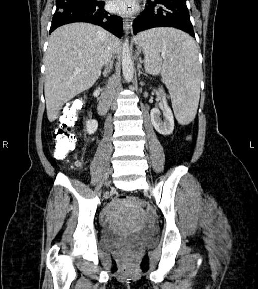 Abdominal lymphoma with sandwich sign (Radiopaedia 84378-99704 Coronal C+ portal venous phase 40).jpg