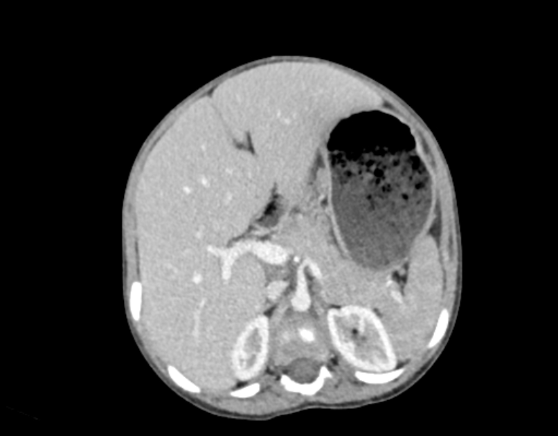 Abdominal premesenteric cystic lymphangioma (Radiopaedia 82995-97350 Axial C+ portal venous phase 16).jpg