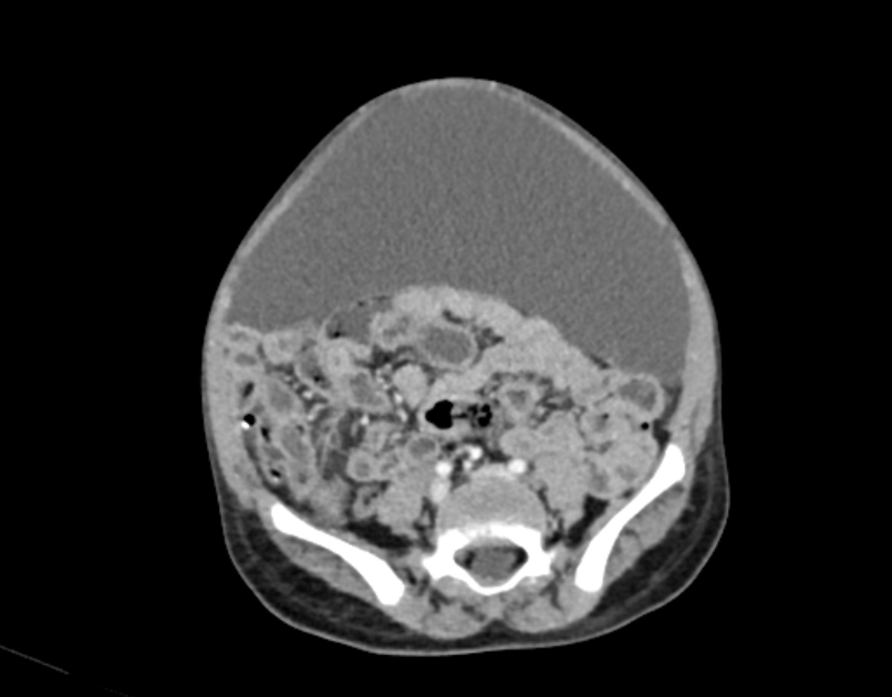 Abdominal premesenteric cystic lymphangioma (Radiopaedia 82995-97350 Axial C+ portal venous phase 44).jpg